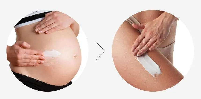 ATOPALM Stretch Mark Cream 150ml